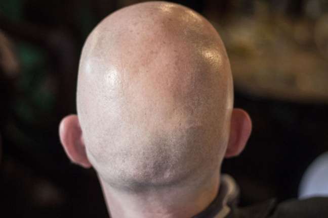 A British Court Has Ruled That Calling A Man Bald Counts As Sexual Harassment Understand 